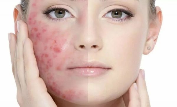 Urban “life” of the skin: rashes and allergies
